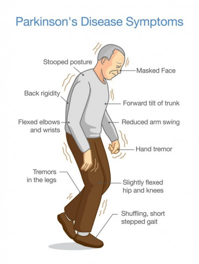 How to recognize symptoms of Parkinson's disease early on